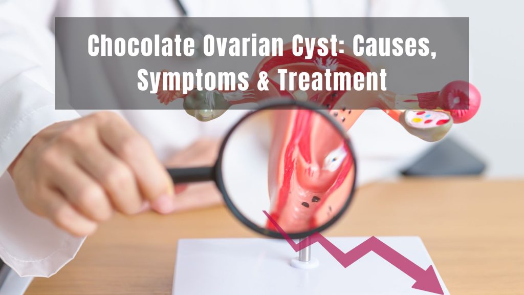 Chocolate Ovarian Cyst