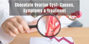 Chocolate Ovarian Cyst