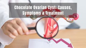 Chocolate Ovarian Cyst